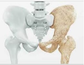 Osteoporóza